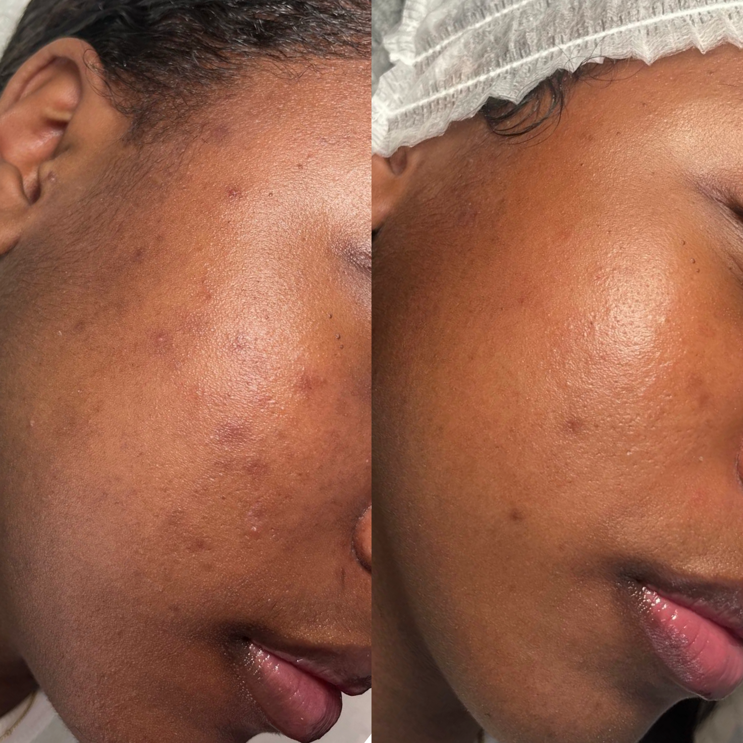 Before and after comparison of a person's face with visible skin texture changes.